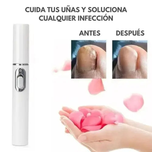LumiNail | Lápiz láser azul para eliminar hongos en las uñas