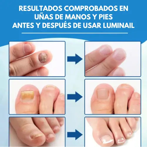 LumiNail | Lápiz láser azul para eliminar hongos en las uñas