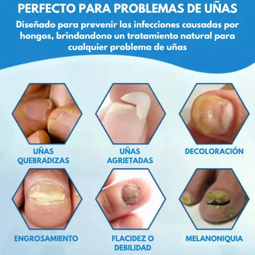 LumiNail | Lápiz láser azul para eliminar hongos en las uñas