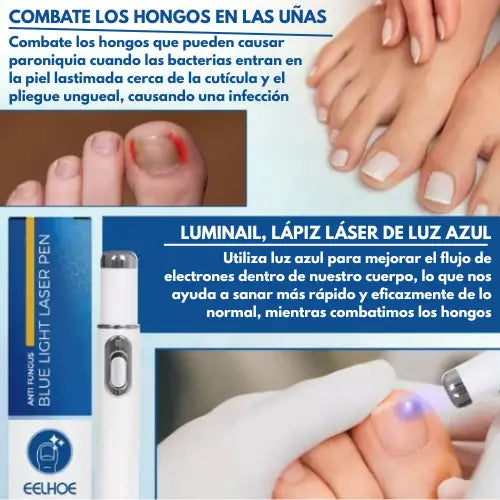 LumiNail | Lápiz láser azul para eliminar hongos en las uñas