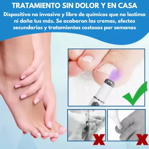 LumiNail | Lápiz láser azul para eliminar hongos en las uñas